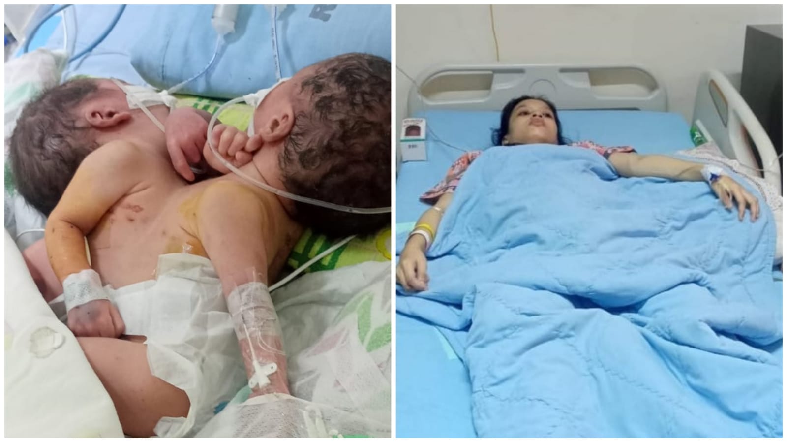 Bayi Kembar Siam Dempet Dada Cuma Punya Satu Jantung, Orangtua Butuh Bantuan
