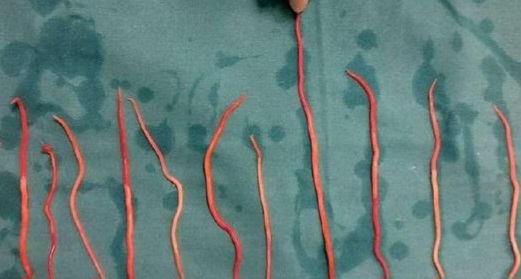 Fakta Unik Cacing Gelang yang Menginfeksi Bocah di Sukabumi hingga Meninggal