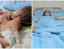 Bayi Kembar Siam Dempet Dada Cuma Punya Satu Jantung, Orangtua Butuh Bantuan