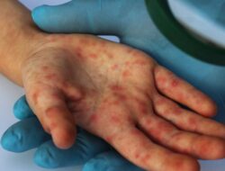 Varian Baru Flu Singapura di Indonesia, Begini Penjelasan Menkes